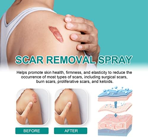 Scar Remove,Scar Remove Medical Grade Scar Spray,Etuih Scar Removal Spray,Acne Scar Treatment for Face, Acne Scars and Dark Spaot Remover, Gentle Skin Care for Acne Prone Skin (2PCS)