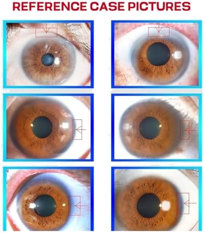 8 Million Pixels Iriscope Diagnostic Eye Analyzer, Analysis Iridology Camera USB Dual Image Display Iriscope for Beauty/Salon/Hospital