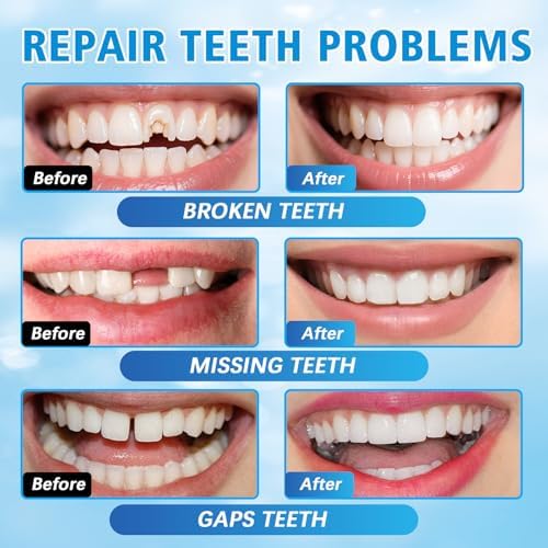 Tooth Repair Kit, Moldable False Teeth Beads, DIY Temporary Tooth Replacement Kit, Suitable for Missing, Broken and Chipped, Tooth Repair Beads Make You Smile Confidently-1PCS
